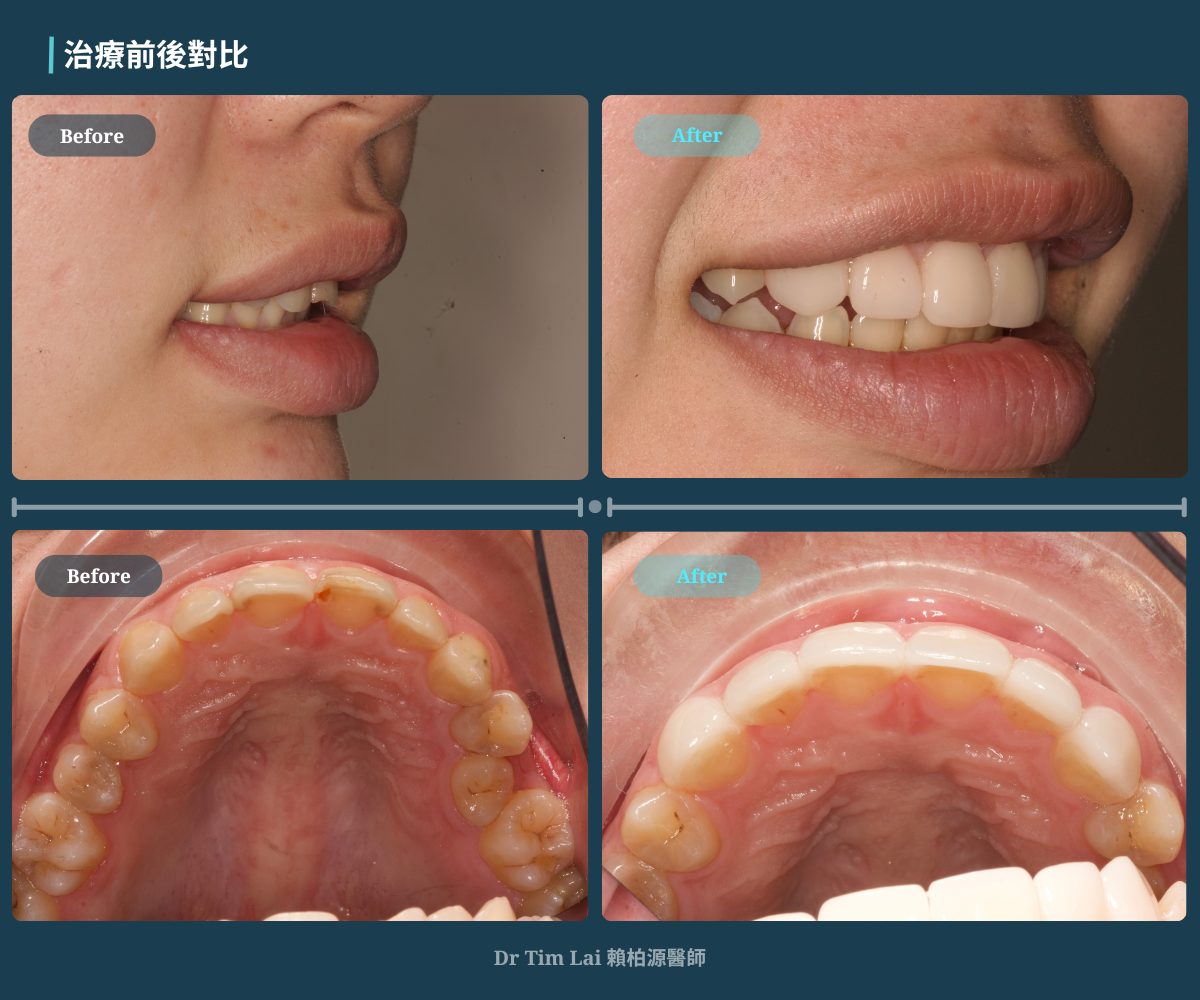 Before  After 4 bar (1)