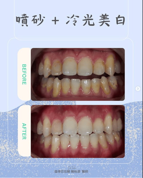 噴砂美白