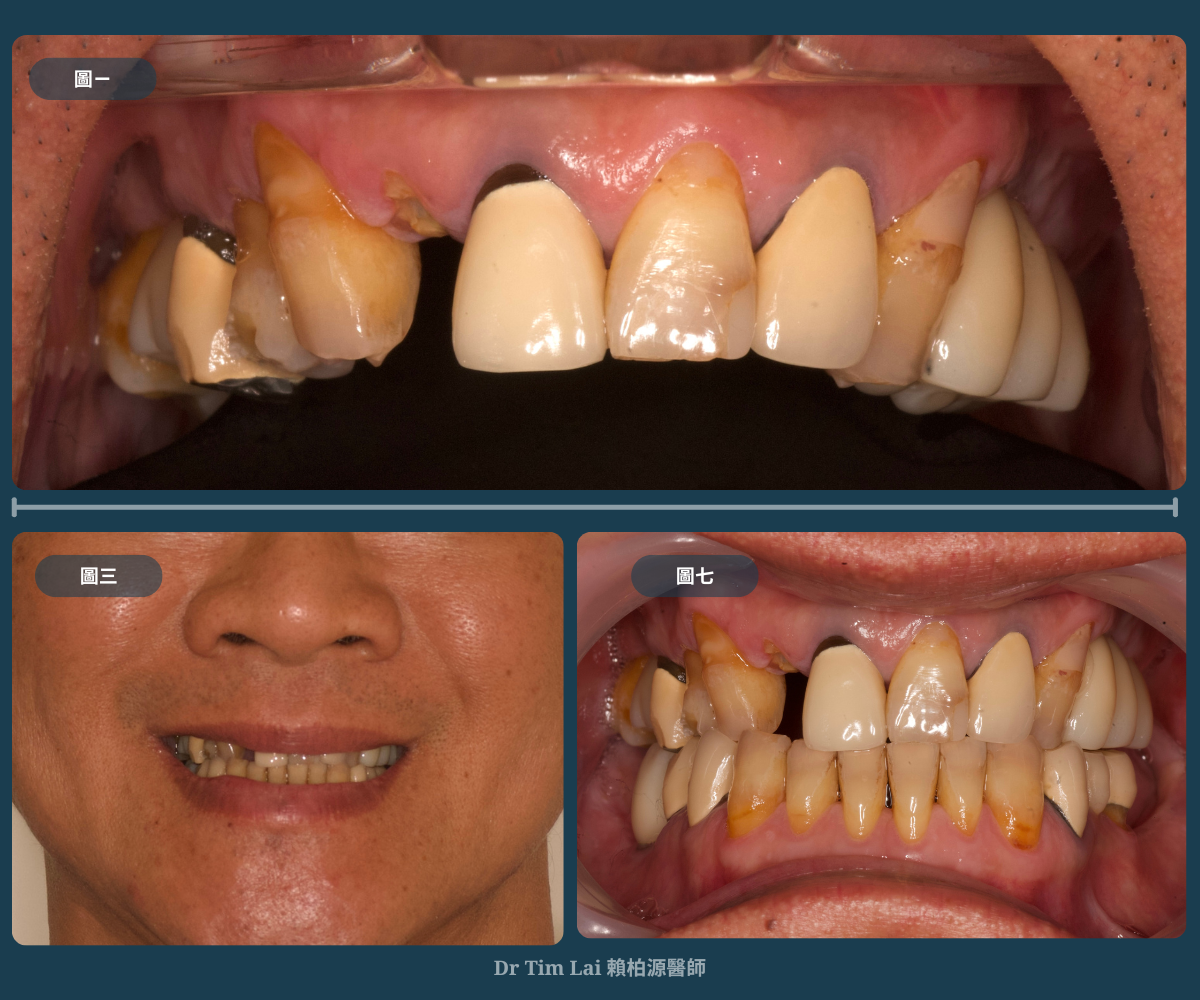 植牙美學重建 Before  After 4 bar (3)