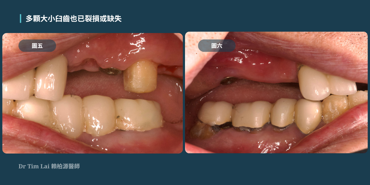 無痛全口重建之路3