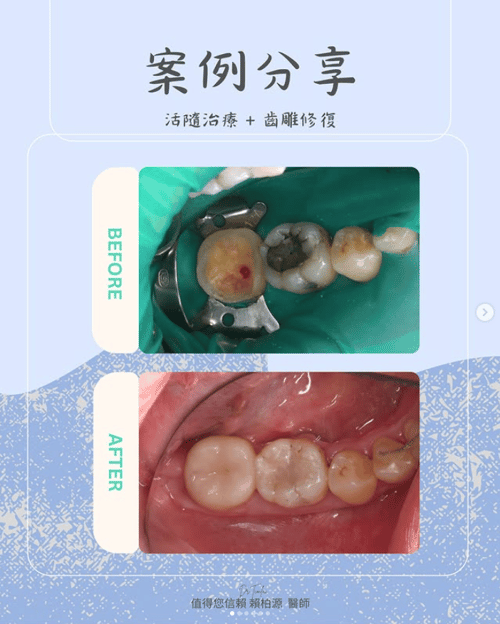 髓治療+陶瓷嵌體修復
