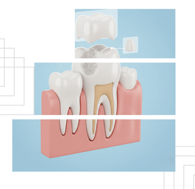 Ceramic Inlays & Onlays_02_website Ceramic Inlays & Onlays_02_website