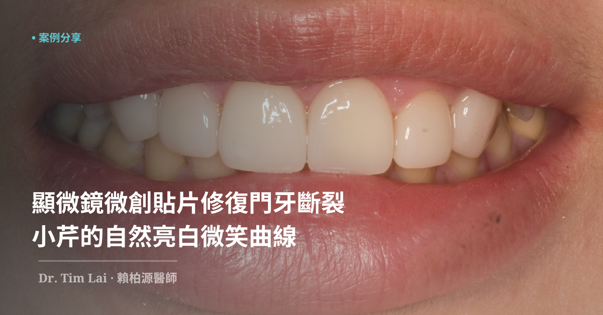 顯微鏡微創貼片修復門牙斷裂，小芹的自然亮白微笑曲線