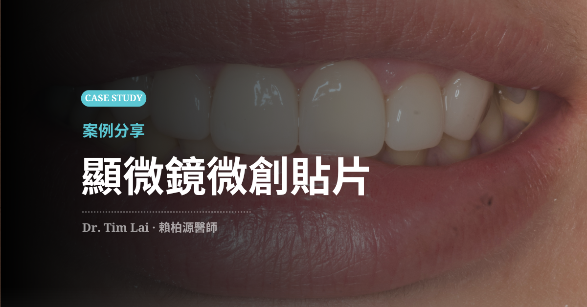 顯微鏡微創貼片修復門牙斷裂，小芹的自然亮白微笑曲線