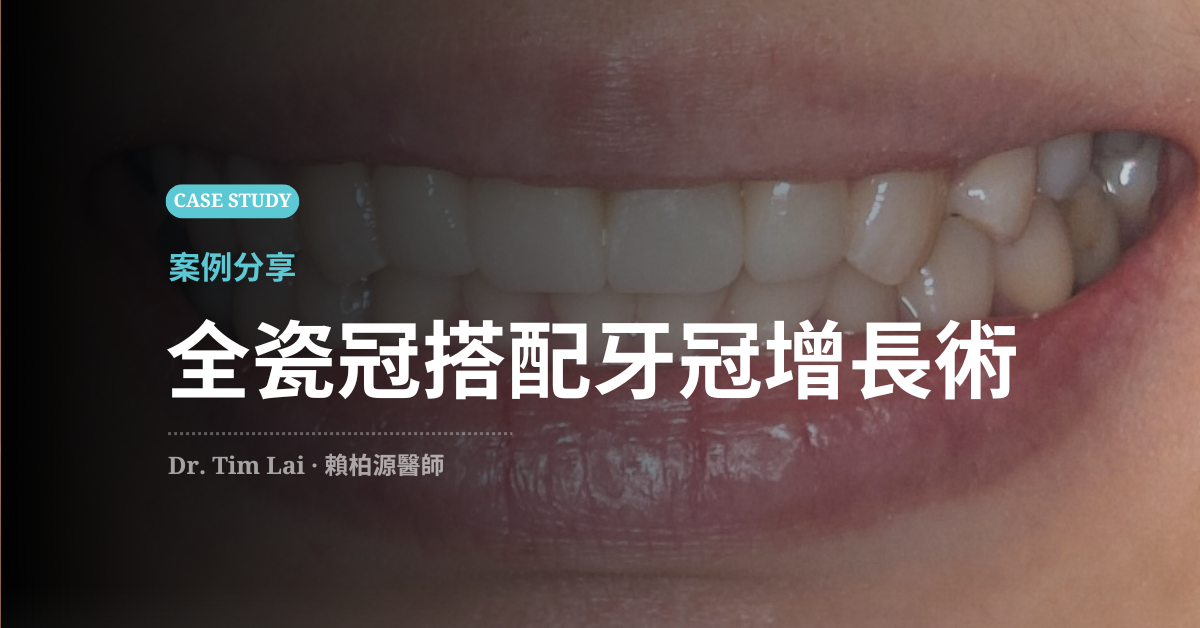 全瓷冠改善微笑曲線