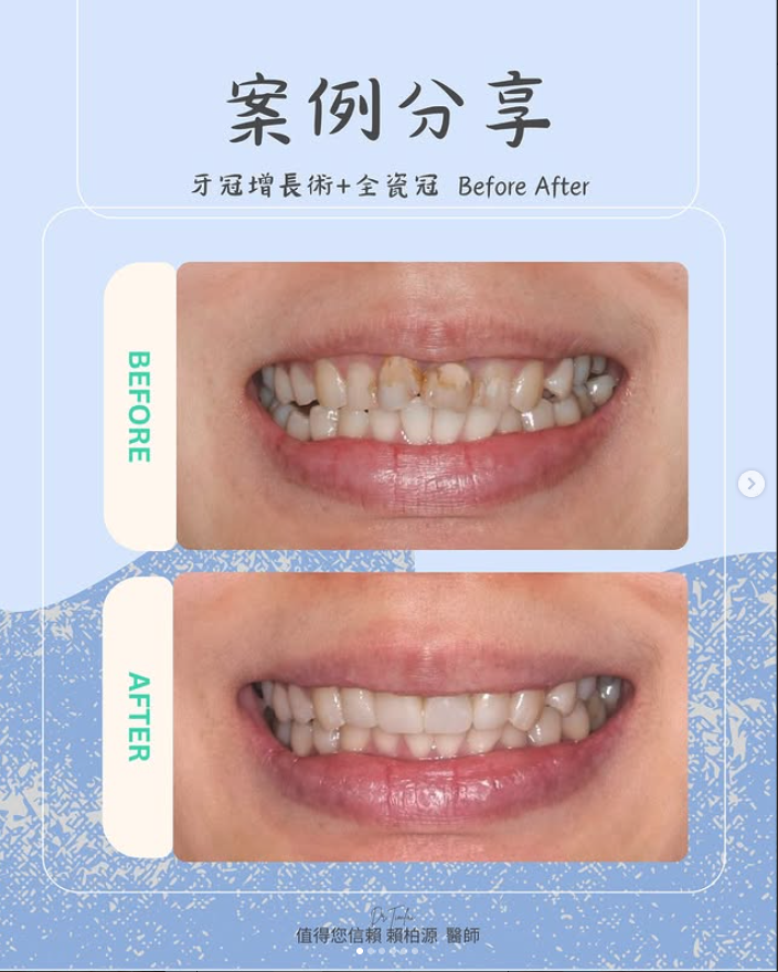 全瓷牙冠案例分享