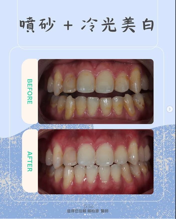 噴砂美白案例分享
