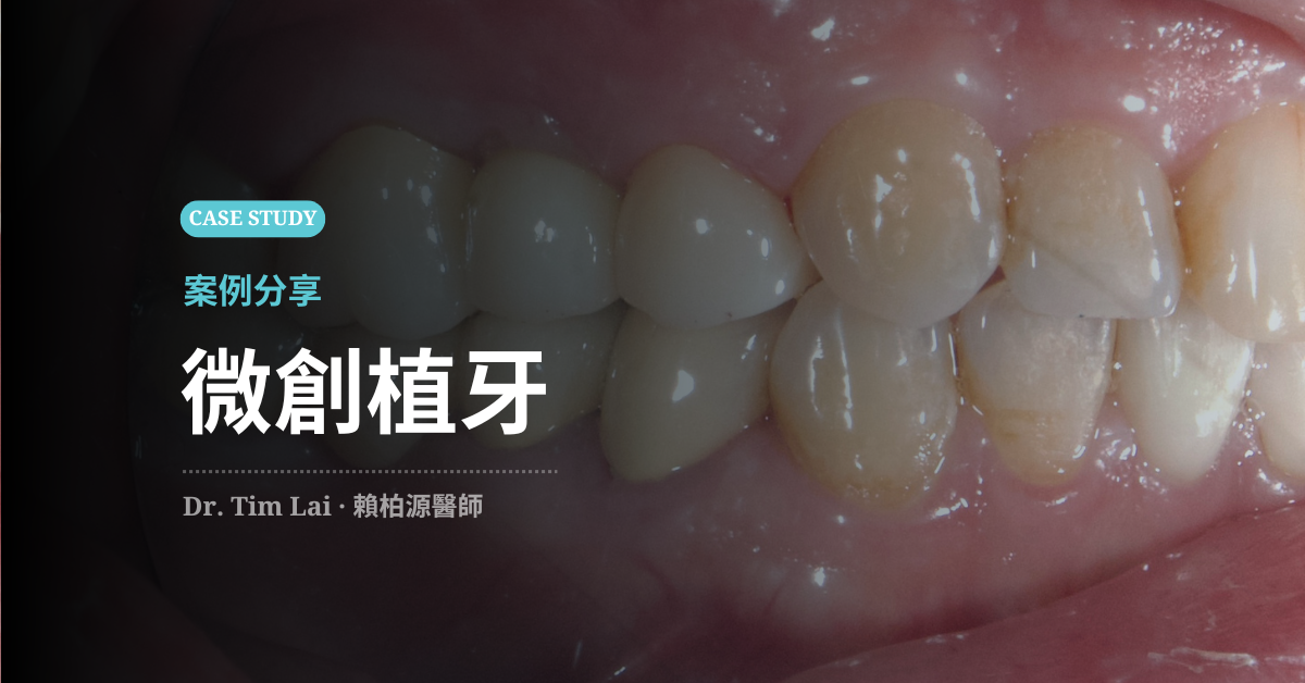 微創植牙案例分享