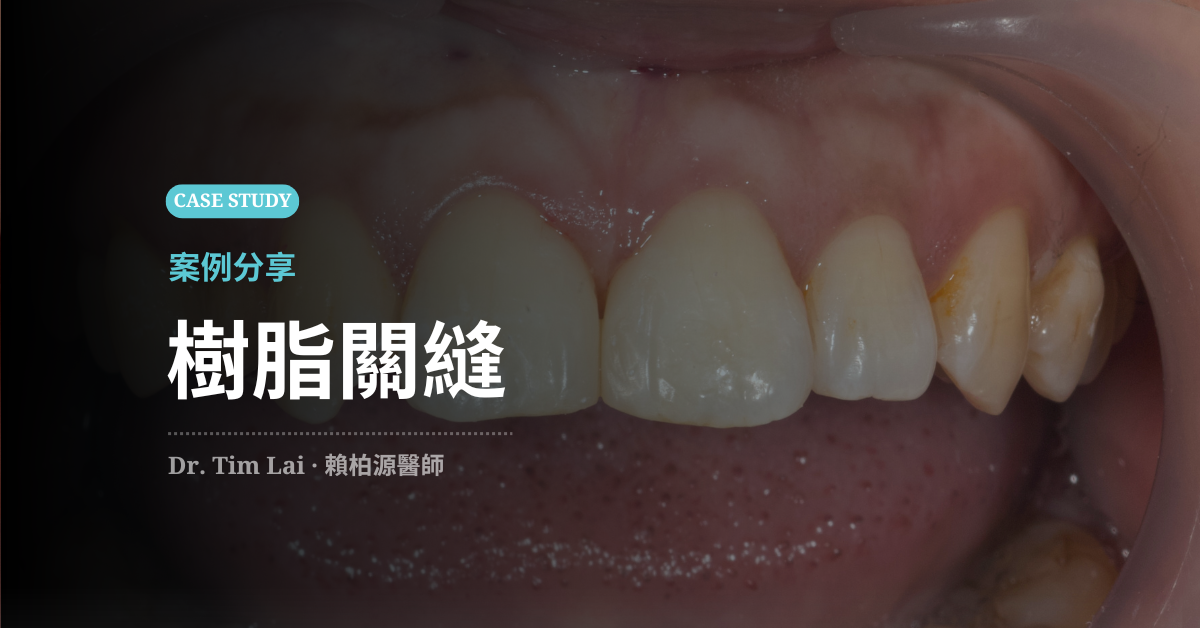 微樹脂關縫