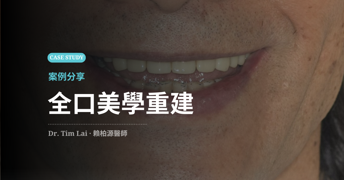 全口美學重建推薦案例