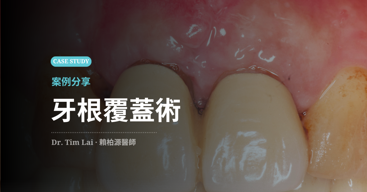 透過「牙根覆蓋術」逆轉牙齦萎縮，兼顧紅白美學與保留真牙