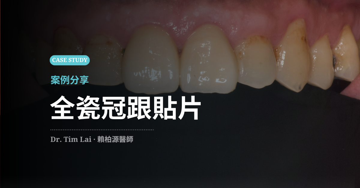 全瓷冠跟貼片差在哪裡？看懂兩者差異與微創修復過程