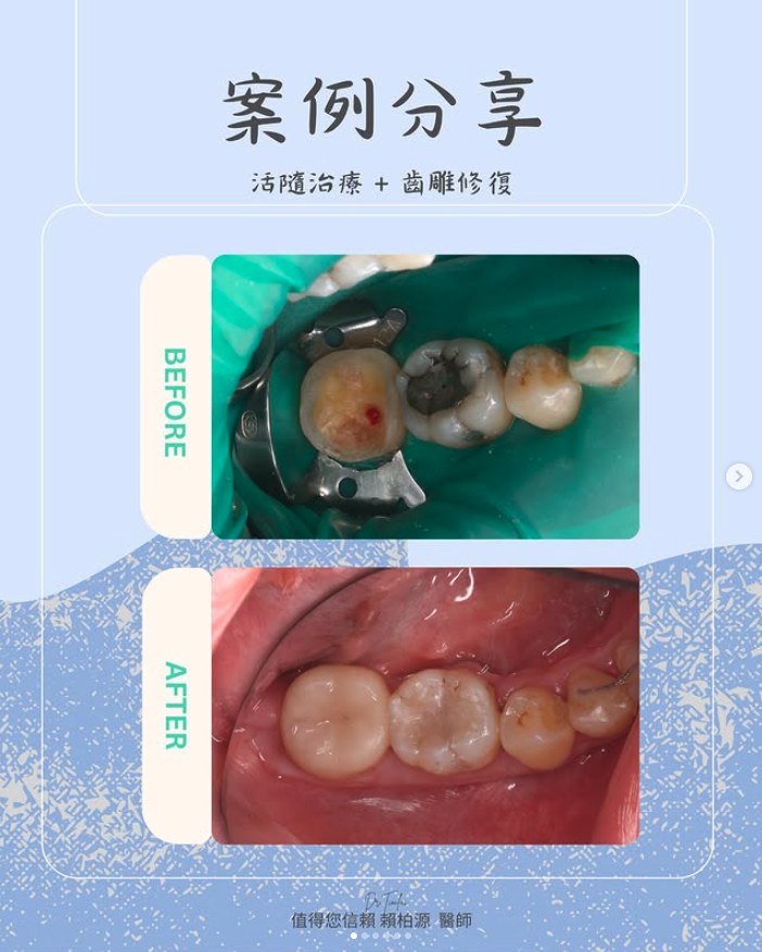活髓治療陶瓷嵌體修復案例分享